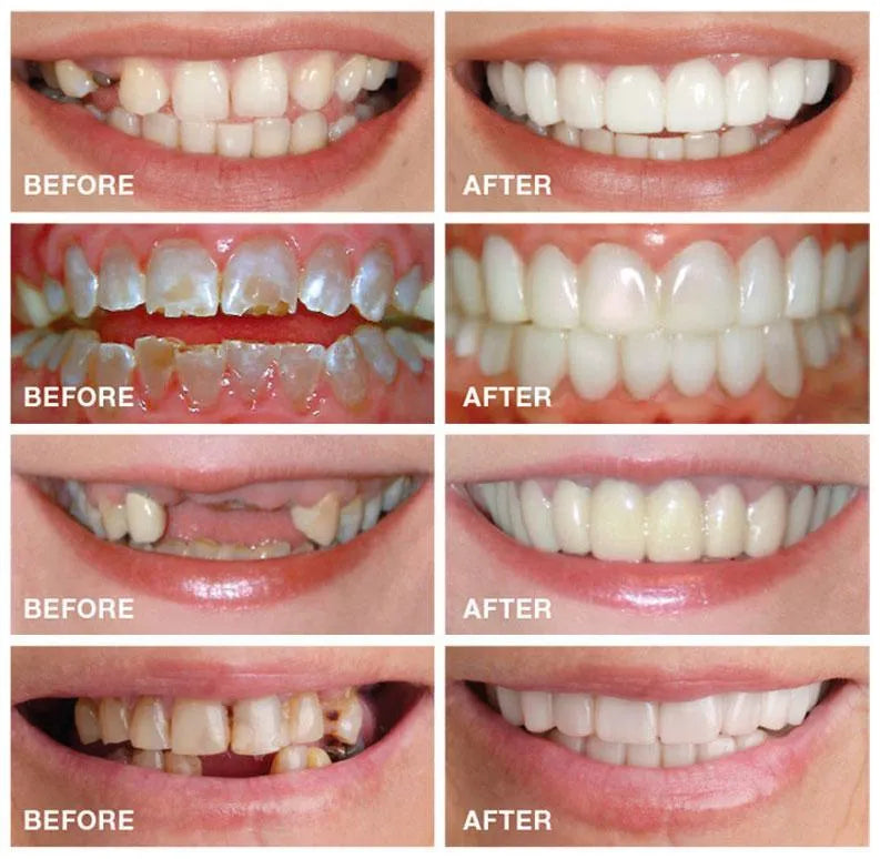 Snap On Fake Teeth Set